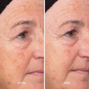 Liquid Resurfacing Solution Daily Leave-On Exfoliant
